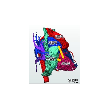 [선천성 심장병]수정 대혈관 전위증